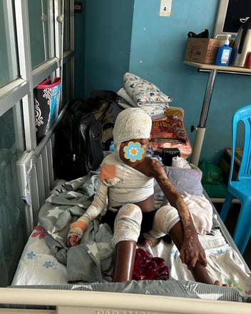 Compassion in Action, Delivering Urgent Burn Care in Uganda